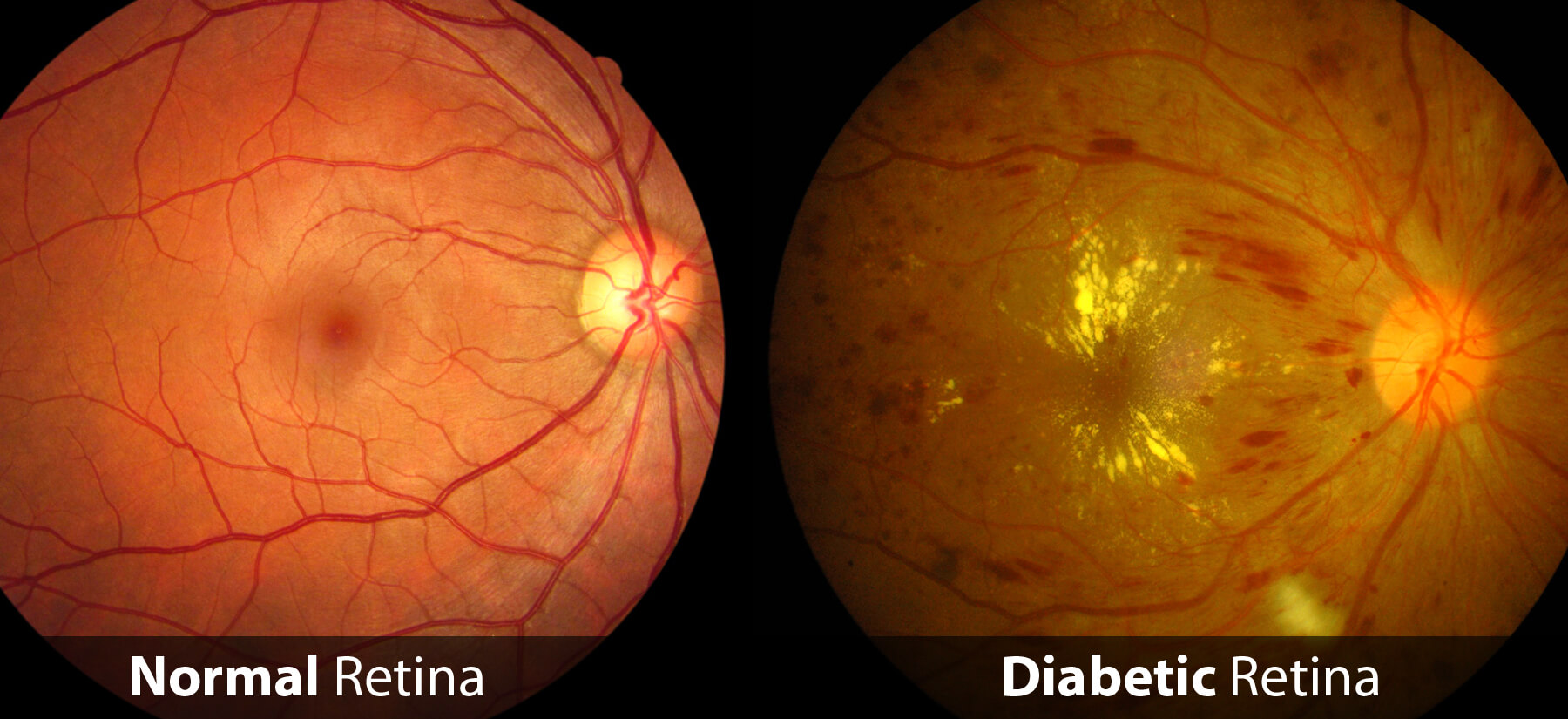 Imagine despre Retinopatia Diabetica