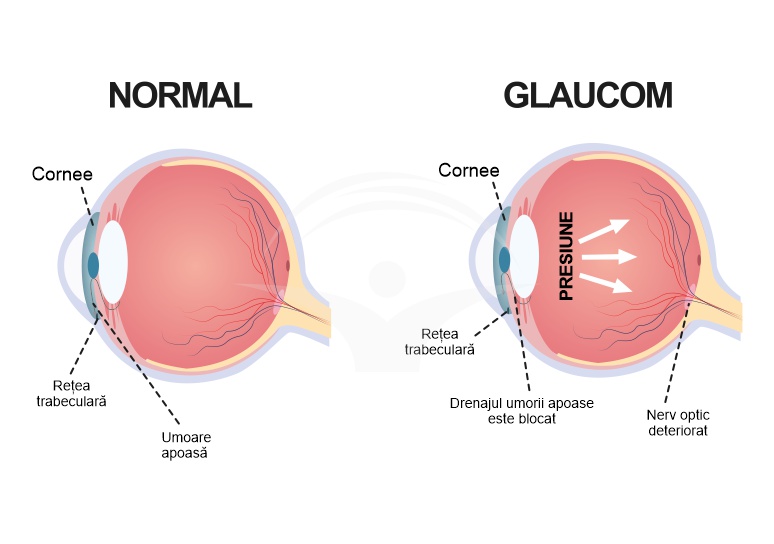 Imagine despre Glaucom